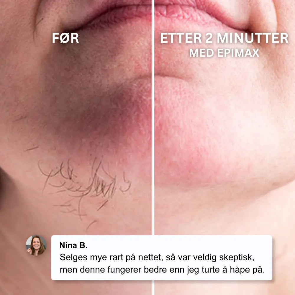 Epimax® - Fjerner alle typer ansiktshår på sekunder