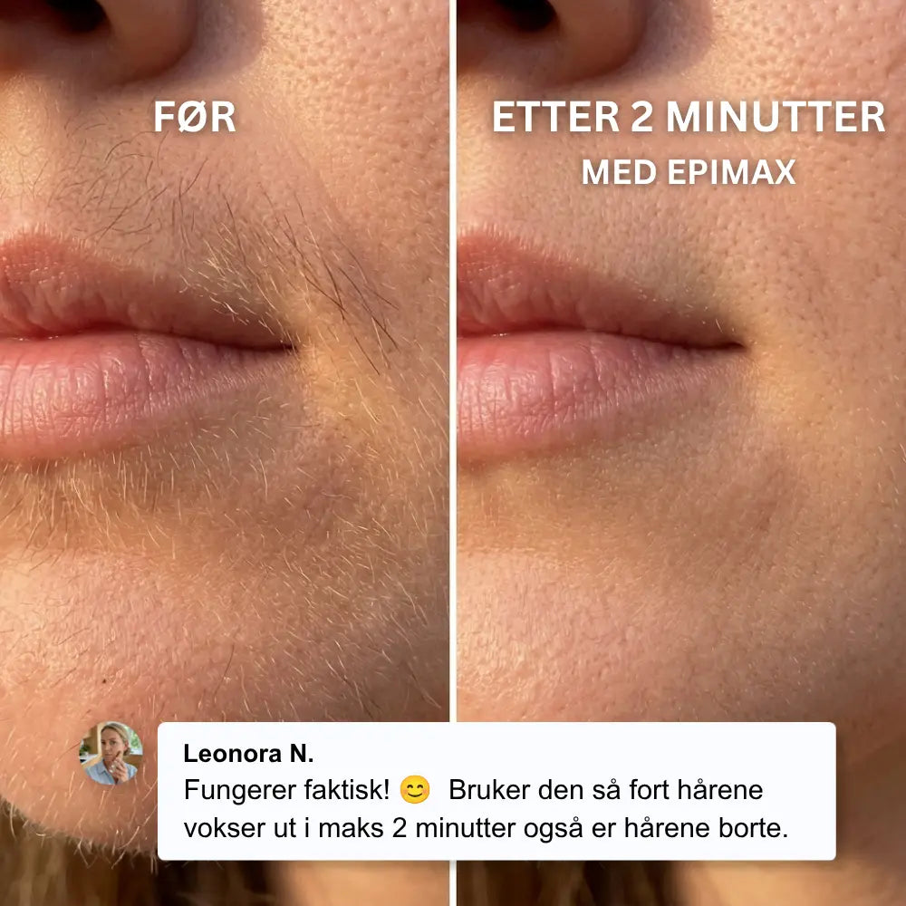 Epimax® - Fjerner alle typer ansiktshår på sekunder