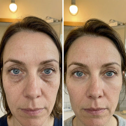 EyeLift® - Fjerner poser og ringer under øynene