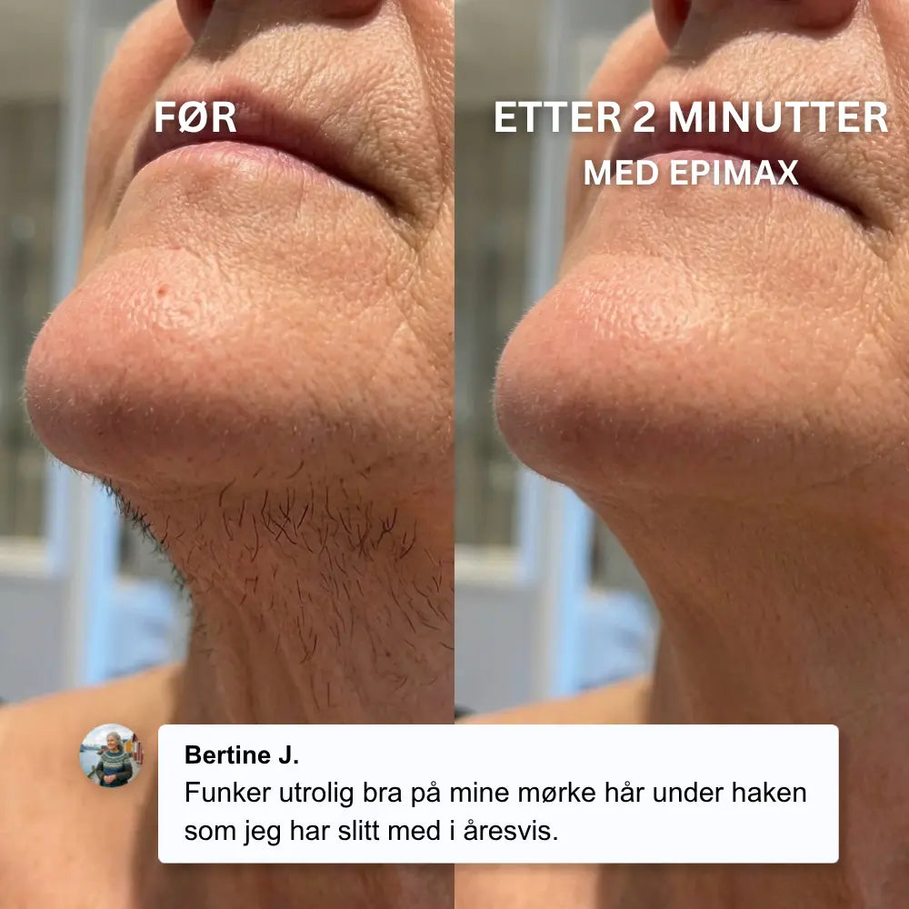Epimax® - Fjerner alle typer ansiktshår på sekunder